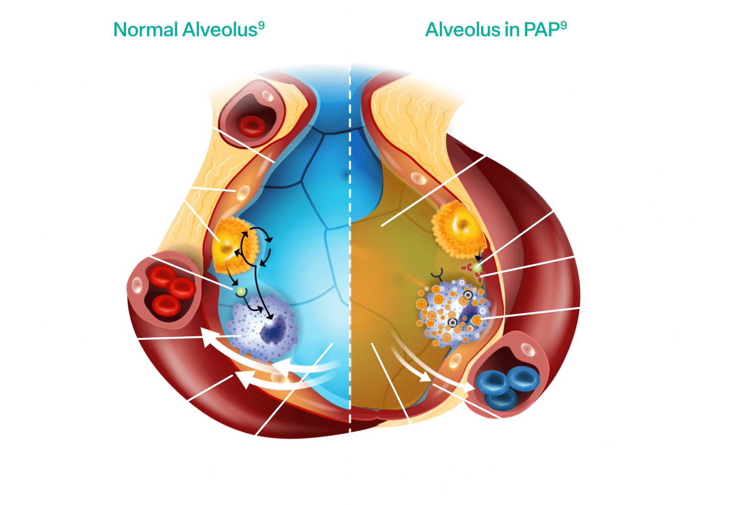 Normal alveolus vs alveolus with aPAP