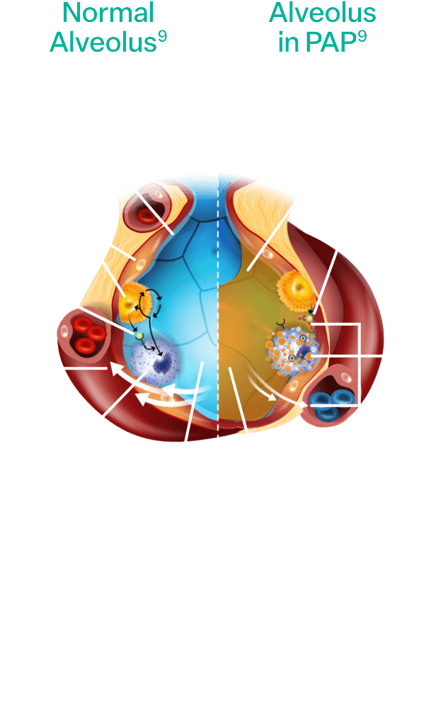 A side-by-side of normal alveolus vs alveolus with aPAP. With aPAP, the alveolus has a thicker surfactant layer, a lipid filled alveolar macrophage, reduced oxygen delivery and the presence of GM-CSF autoantibodies.